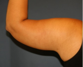 Feel Beautiful - Arm Reduction 209 - After Photo